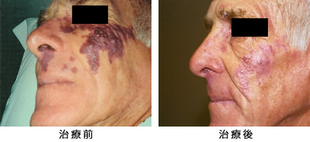 単純性血管腫