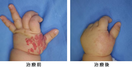 苺状血管腫