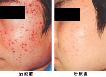 毛細血管拡張症